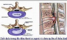 Giường kéo giãn cột sống và phương pháp điều trị hiệu quả