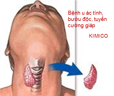 Chữa bệnh u ác tính, bướu độc, bướu cổ, tuyến cường giáp Y Khoa Kim Minh